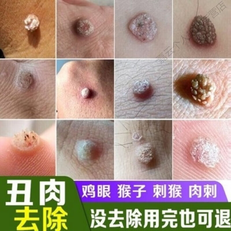 祛丝状去除扁平尤i疣膏脖子颈部腋下肉粒 刺猴子肉跖i疣寻常i疣去刺
