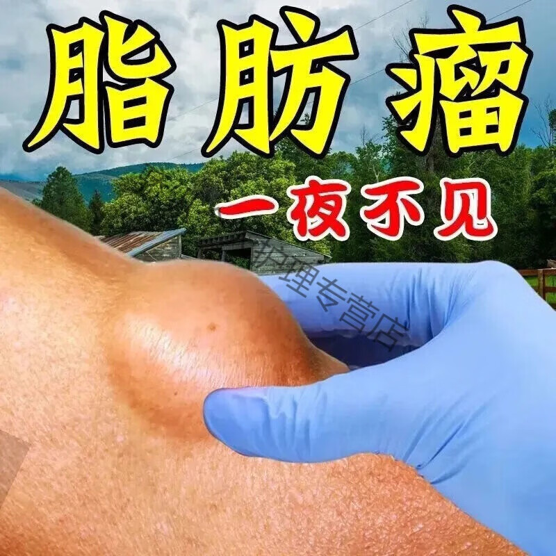 苏季善效脂肪瘤克星专消皮下脂肪瘤囊肿硬块凸起中yao膏 买2 1 90g丨