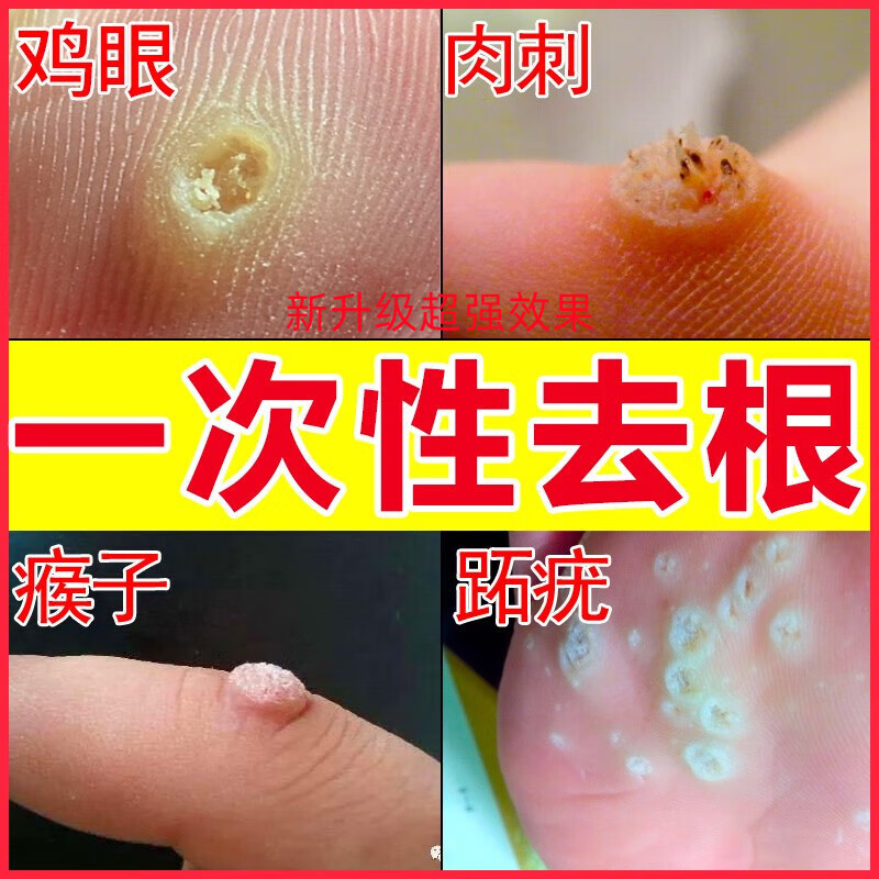 灵肉刺瘊子扁平丝状跖尤老茧脚垫草本液瘊优平克疣液 瘊疣灵10ml 棉签