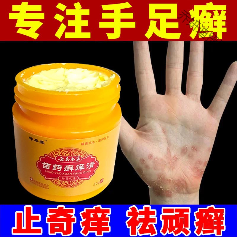 【顽癣】牛皮l癣膏银i屑病牛皮l癣专用体l癣头l癣手足l癣湿l疹止痒膏