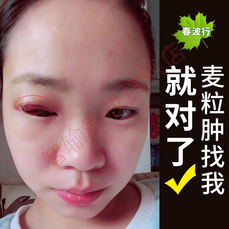 麦粒肿贴撅眼绝眼针眼贴睑腺炎麦粒肿膏沙眼贴眼贴眼皮长脓肿红肿疼痛