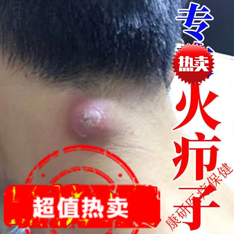 蛇油拔毒膏火疖子脓包拔脓膏痘痘坐板疮脓包狼毒膏毛囊肿湿毒清草本膏