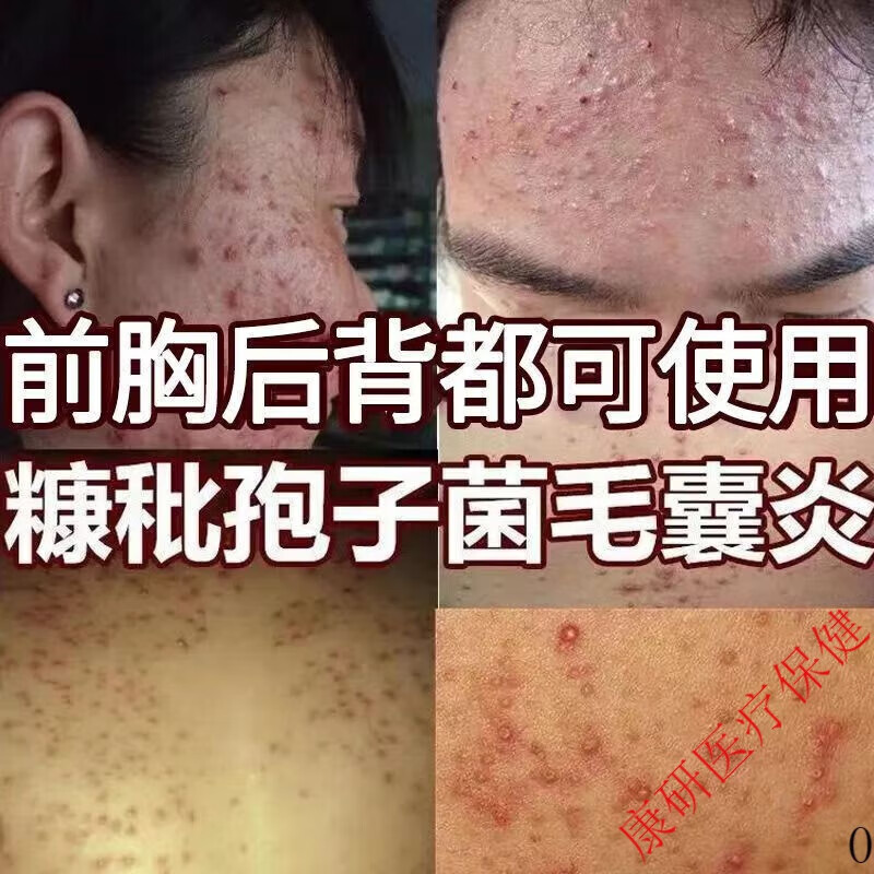 毛囊痒炎型背上硬疙瘩马拉色菌胸部皮肤专用软膏湿痒泡疹皮炎膏火 1盒