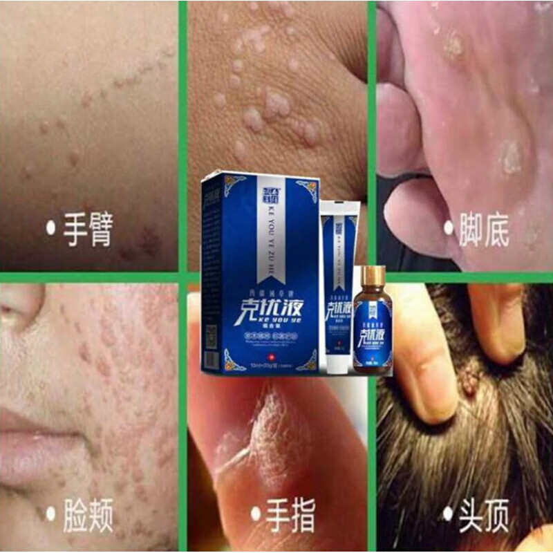 疣立净丝l状l疣颈部面部去除猴子刺猴脖子上长的小肉粒疙瘩颈部腋下皮