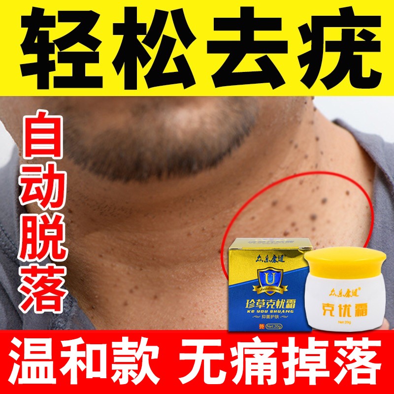 克忧霜五氟脲嘧啶软膏5氟脲嘧啶软膏疣瘊平扁平i疣脸部疣必治去猴子肉