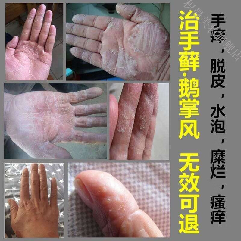 手l癣膏手足l癣真菌感染水泡手痒脱皮干裂湿l疹止痒膏鹅掌风箹l膏脚l
