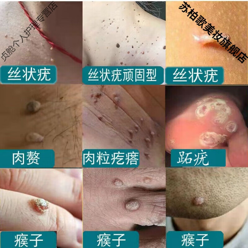 祛除脖子小肉粒小猴子颈部赘皮扁平尤丝状l疣腋下疣