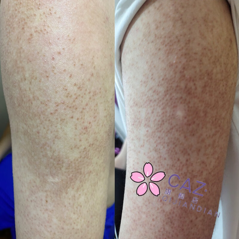 关于鸡皮肤留下的黑斑怎么处理的信息 关于鸡皮肤留下的黑斑怎么处理的信息