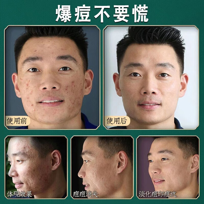 南京同仁堂祛痘膏去痘印痘疤痘坑痘痘肌修护男女学生青春红肿痘闭口粉刺芦荟胶祛痘印凹洞百幽草