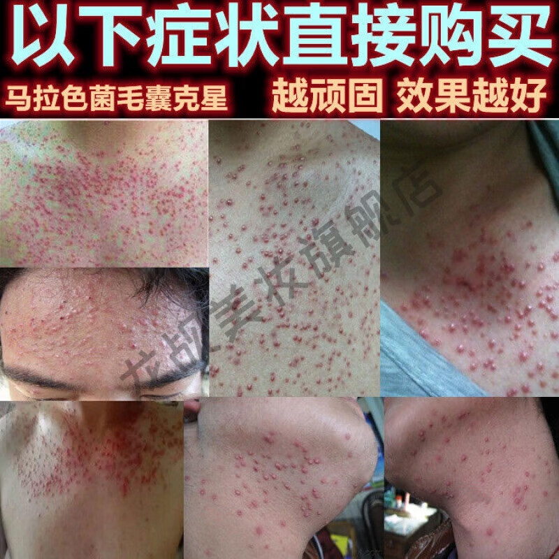 胸前后背部毛囊l炎膏箹治头皮背部胸口四肢皮囊l炎痘痘皮肤瘙痒止痒膏