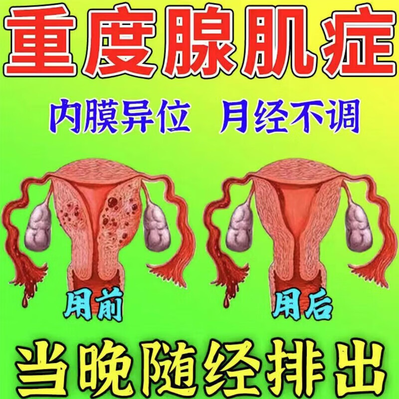 子宫腺肌症贴卵巢囊肿调理1月经1不调增多小腹疼白带过多异味专用中
