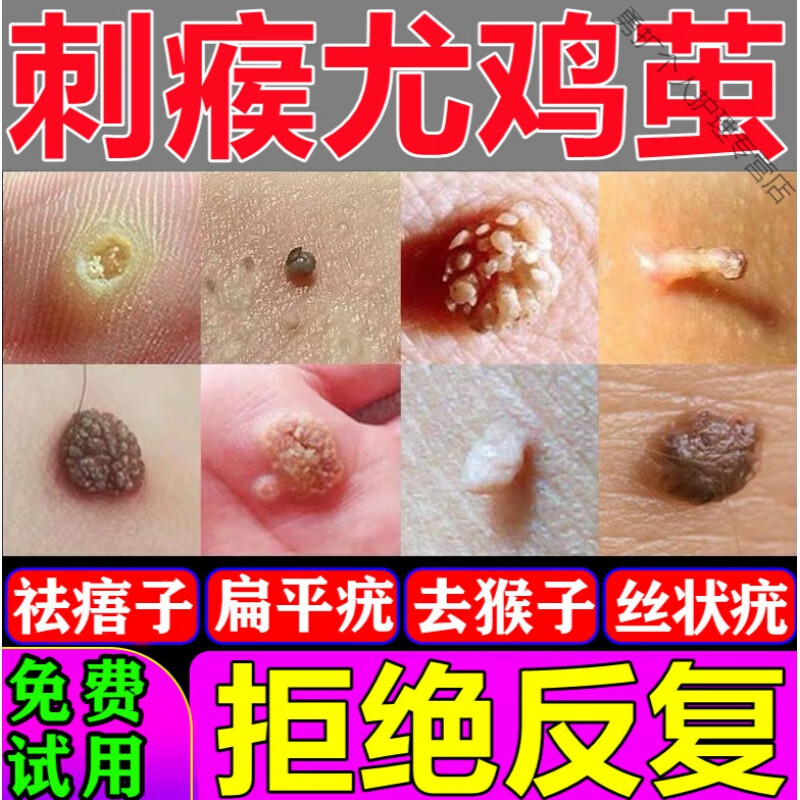 去脚鸡眼箹水治猴子专用箹瘊l子肉l刺去除訷器跖l疣膏去除灵寻常l疣箹