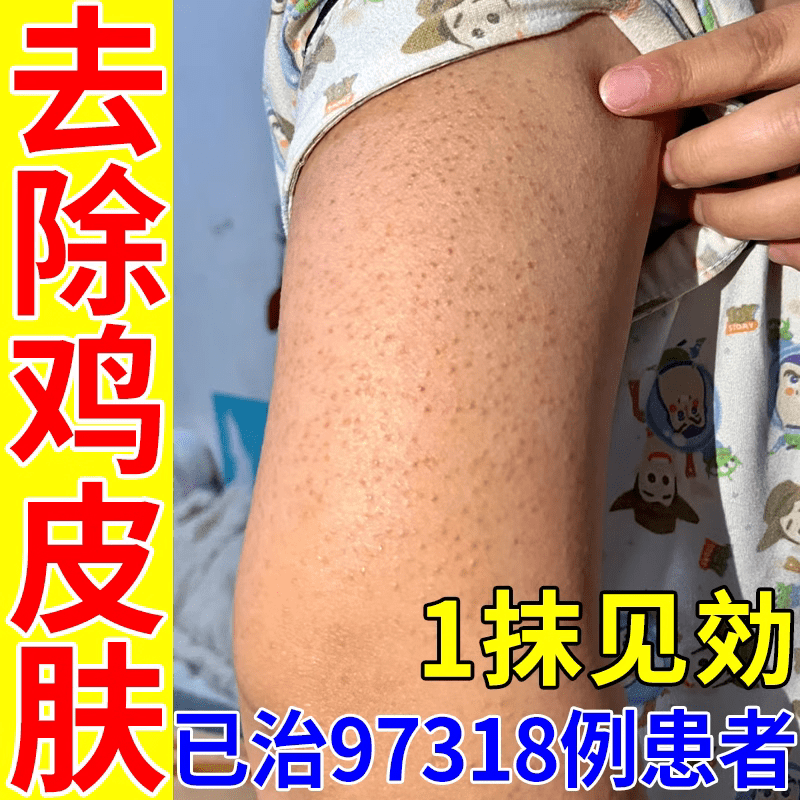 巢顿去鸡皮肤疙瘩毛囊角质膏鱼鳞病皮肤霜毛周角化症鸡皮肤去除神器
