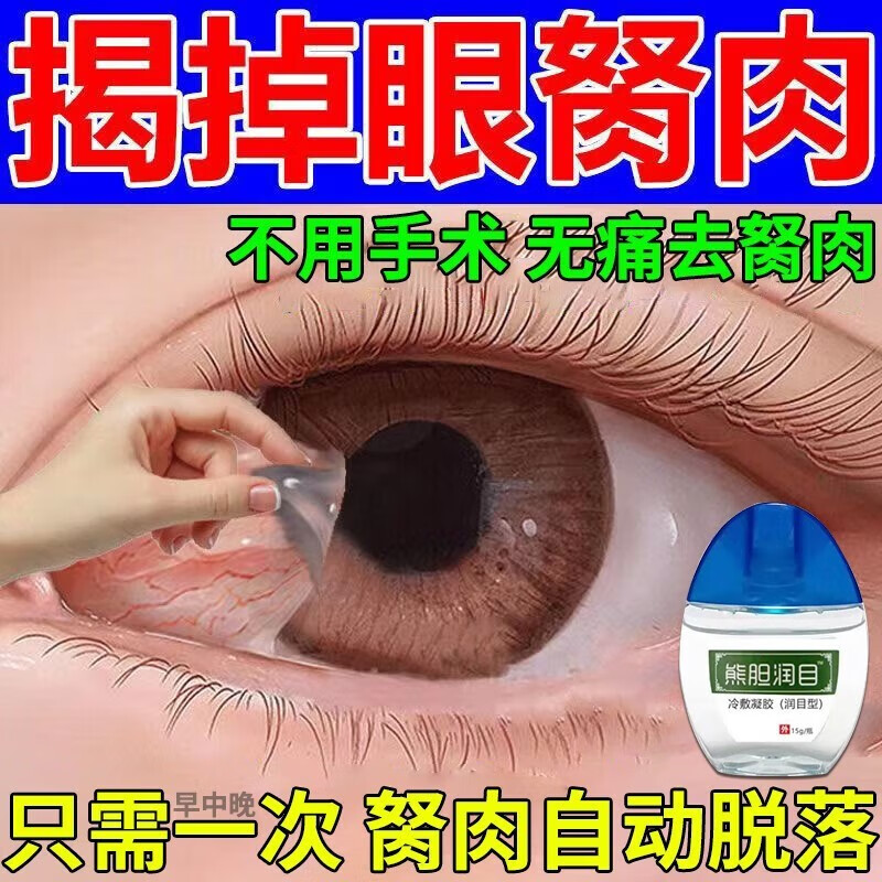 眼睛去胬肉红血丝视力模糊胬肉除翼状息i肉疙瘩眼睛干痒异物感润 8盒