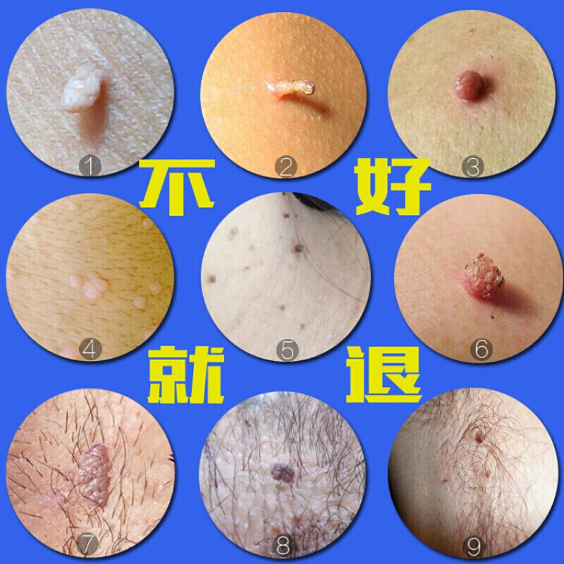 丝状尤去除小肉瘤肉猴子特傚治刺肉膏肉粒老鼠奶老鼠痣疙瘩 老鼠痣