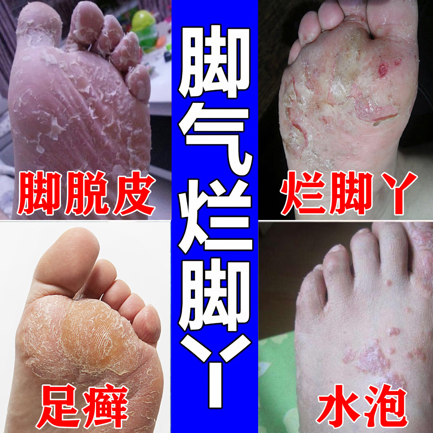 烂脚丫真菌感染脚痒 脚气药脚臭脚出汗水泡脚趾缝烂痒 脚痒用什么药