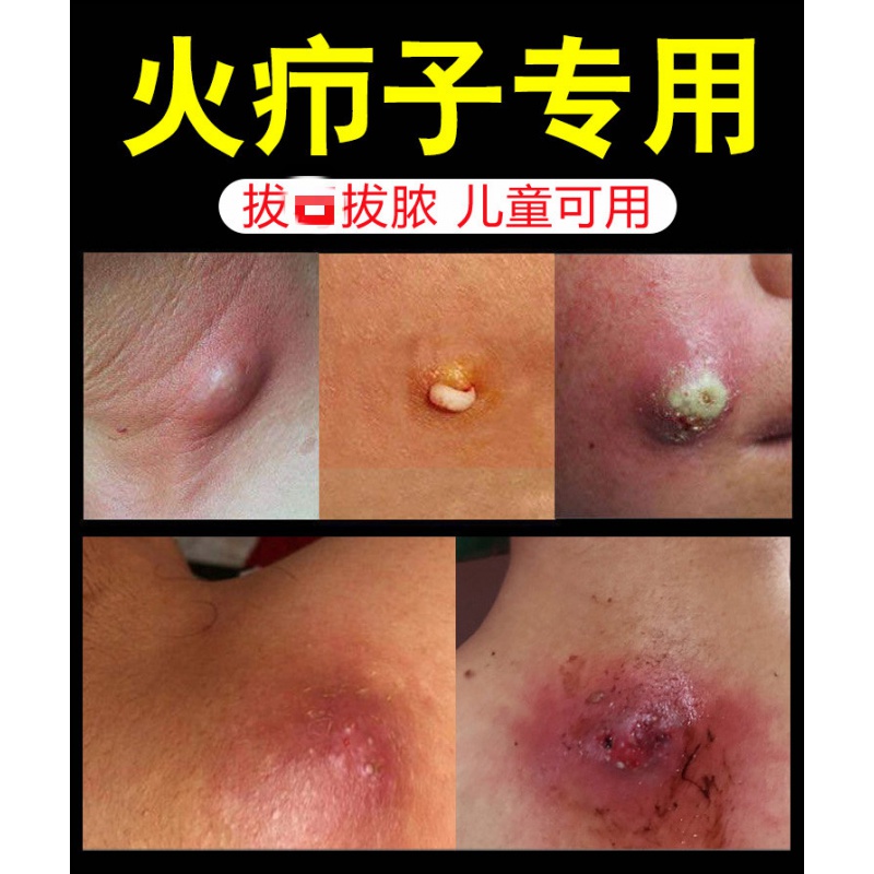 拔i毒膏火疖子疮坐板疮肿硬块脓毒疮去除大红包箹毛囊