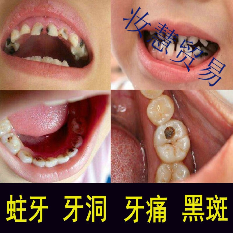 虫牙填补蛀牙修复牙洞牙膏龋齿修复虫牙黑斑儿童洗牙粉成人孕妇牙疼痛
