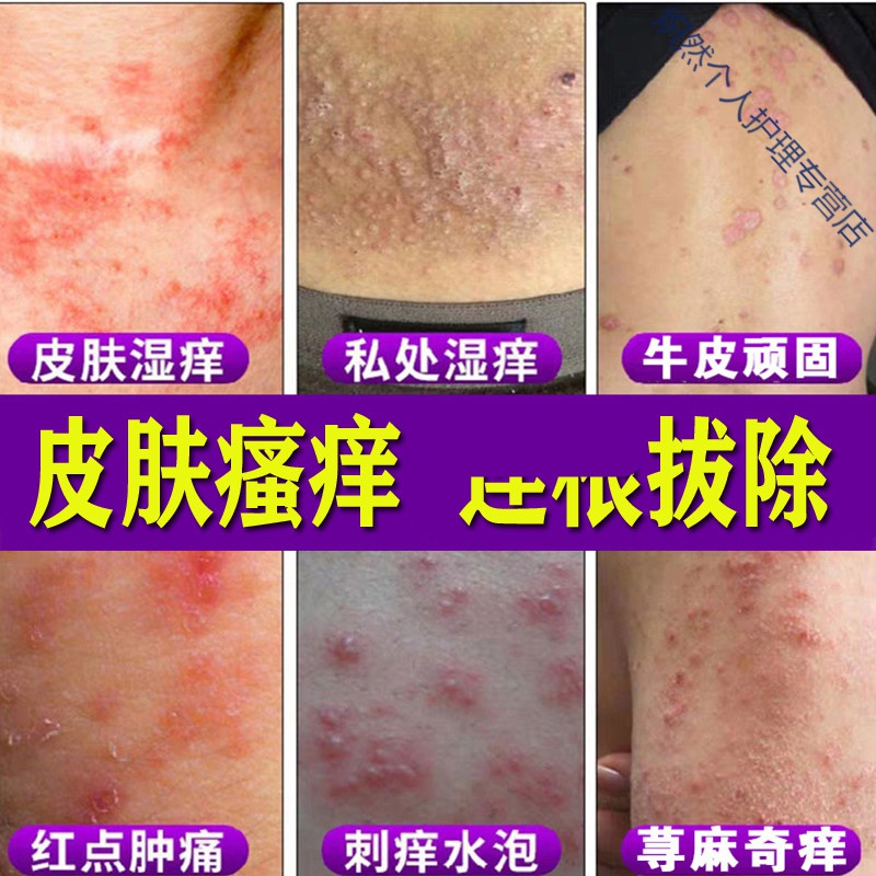 荨麻l疹过敏止痒断l根皮肤瘙痒中箹成分私处抑菌病专用箹克星去l根源