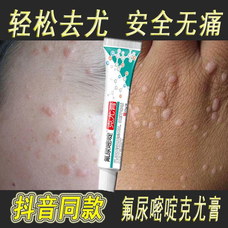 瘊疣膏 疣清宁去瘊疣灵疣体脱落膏疣瘊灵去除脖子小肉粒扁平尖锐疣搭