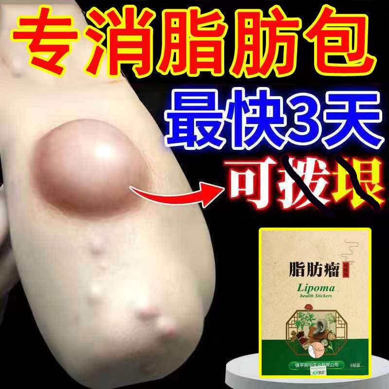 【脂肪瘤克星】脂肪瘤神l器专用膏贴特l效去皮下肿块单发多发性肿块