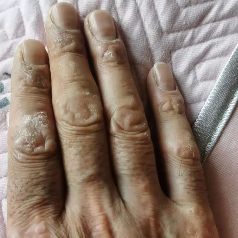 手指关节癣真菌手指关节长硬疙瘩伤癣脱皮干裂手癣真菌感染干裂 3鎹2