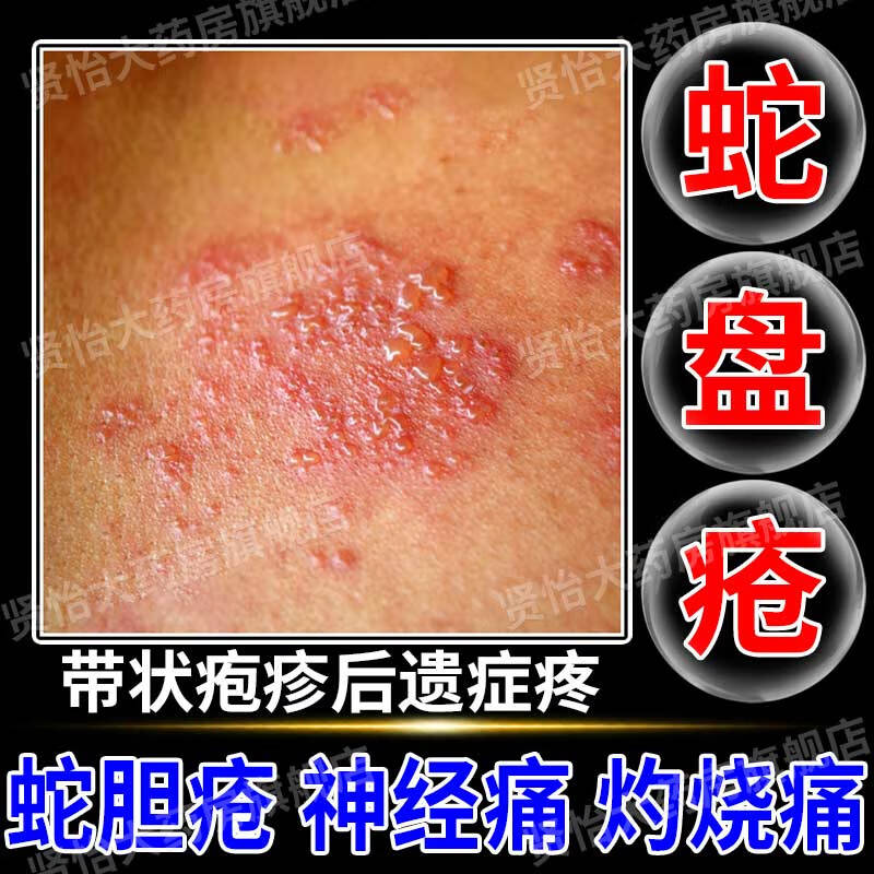 蛇盘疮药膏 治带状疱疹后遗症神经特痛外用药缠腰蛇胆疮水疱病毒感染