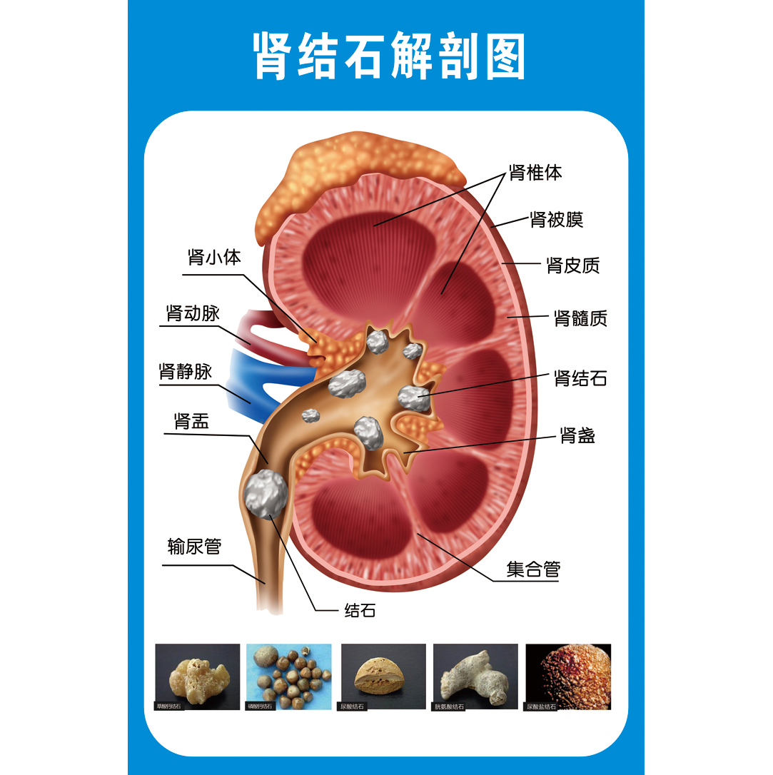 定制适用肾结石泌尿结石解剖图医学宣传挂图人体器官结构图医院海报墙