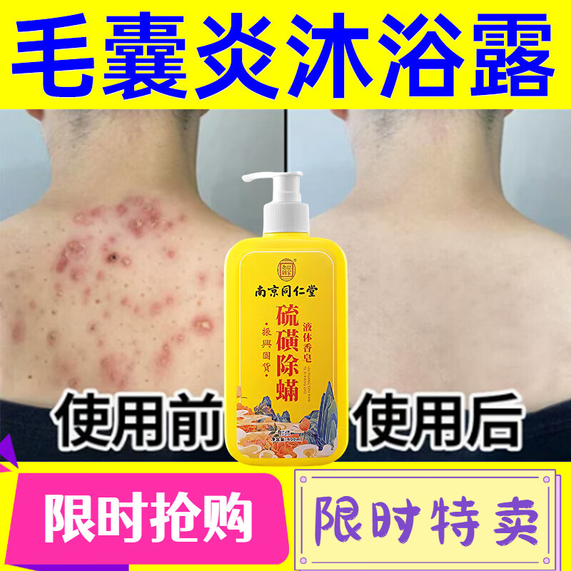 硫磺皂除螨毛囊炎沐浴露除螨去螨虫儿童成人男女士后背长痘祛痘皮肤