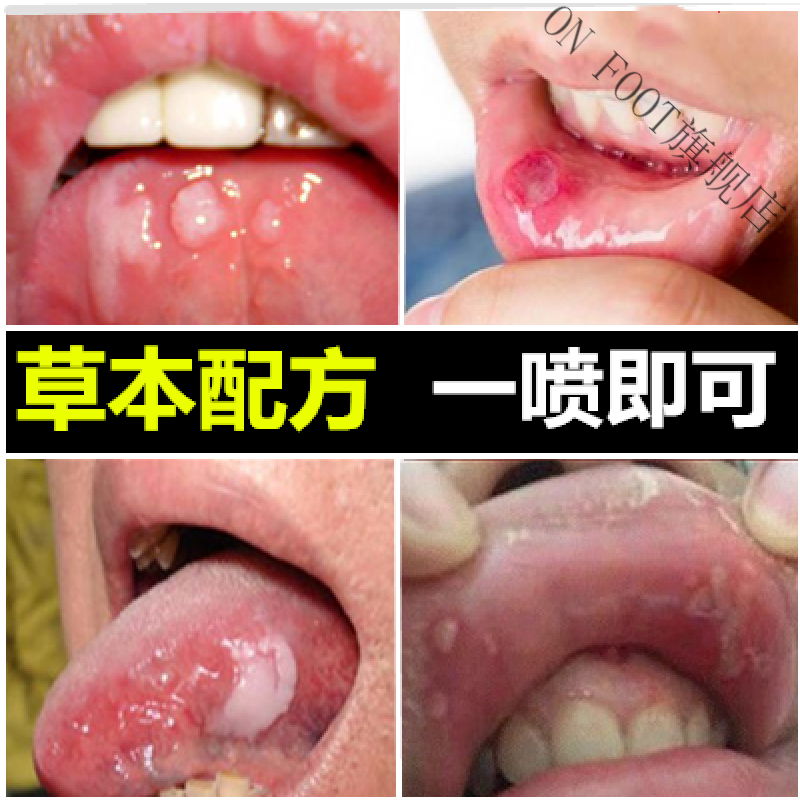 咽炎贴口腔溃l疡喷剂咽l炎喷雾膏贴复发性口l疮水口舌生l疮上火起泡