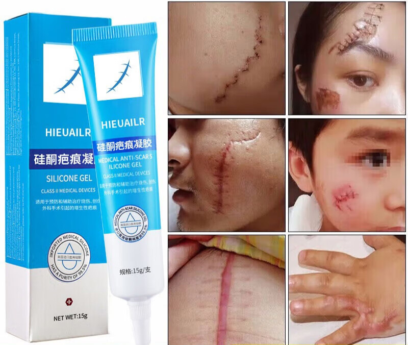 美国出口品质硅酮疤克巴克祛疤膏透明质酸硅凝胶疤儿童面部脸上缝剖腹