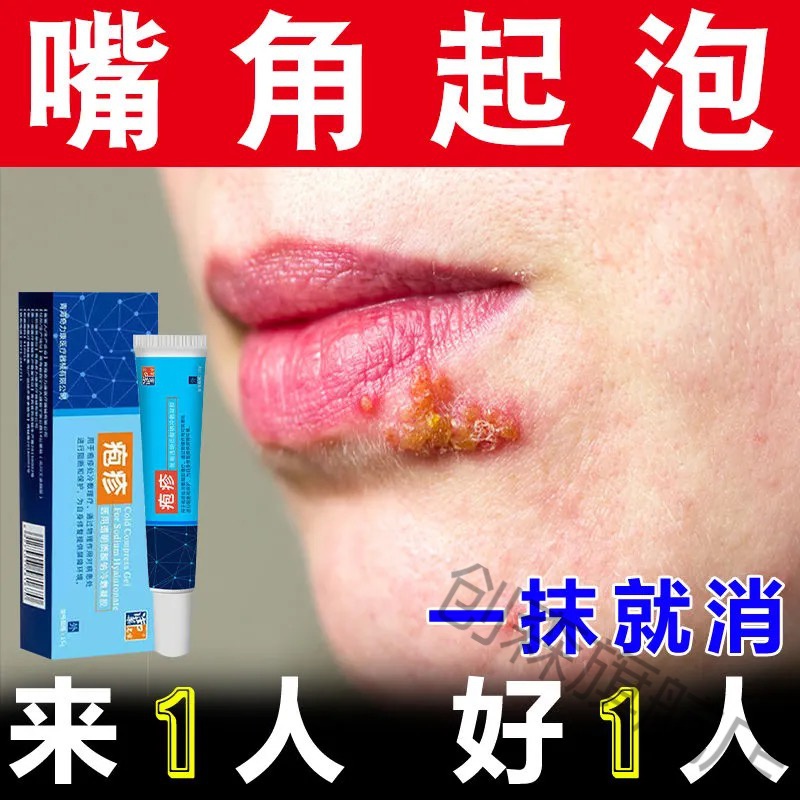 嘴角气泡汗状疱l疹真菌感染水泡专用软膏湿l疹手痒脱皮手足l癣鹅掌风