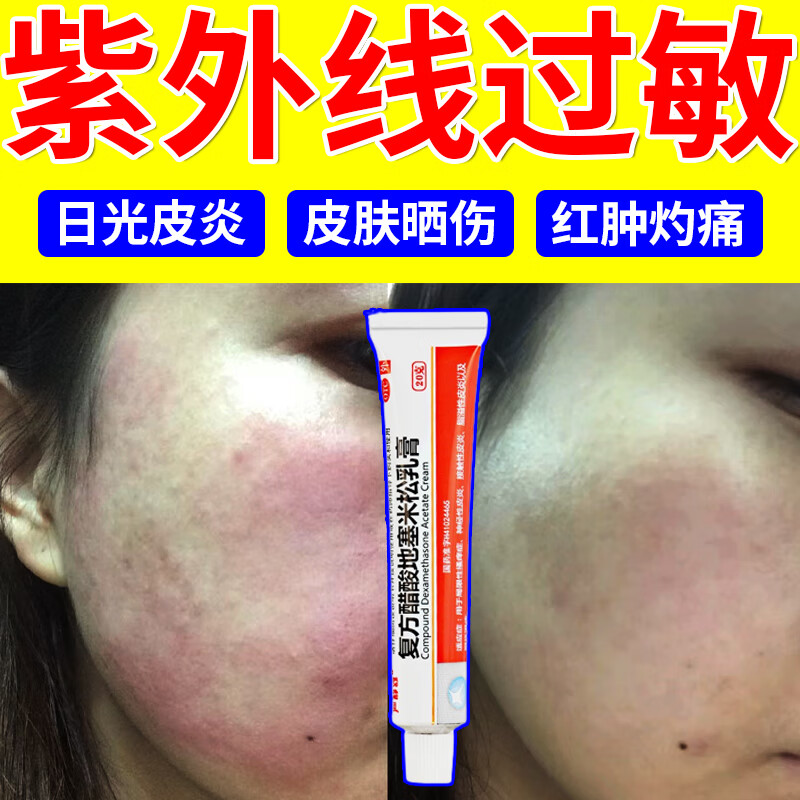 紫外线过敏专用药膏 光敏性日光性皮炎脸部皮肤过敏药皮肤瘙痒止痒药