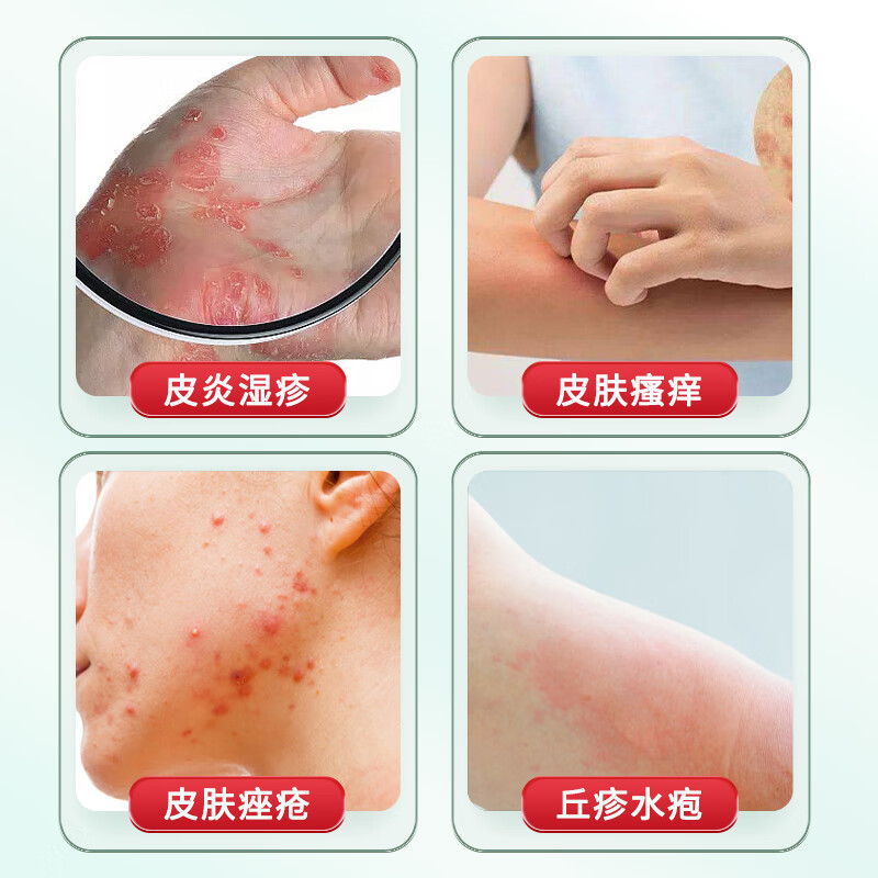 肤痒康草本乳膏肤痒清软膏皮肤偏方抑菌乳膏日光性皮肤大腿内侧瘙痒龟