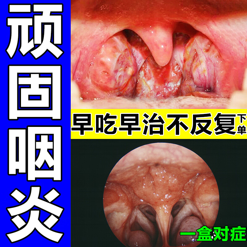 治咽炎专用药喉咙痒.干咳.
