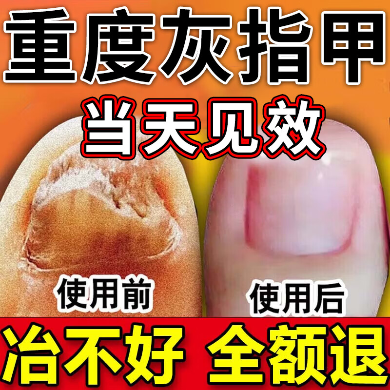 灰指甲特傚效药指甲艮治正膏真菌感染脱甲坏甲坏死脚指甲脱甲 3盒一抹
