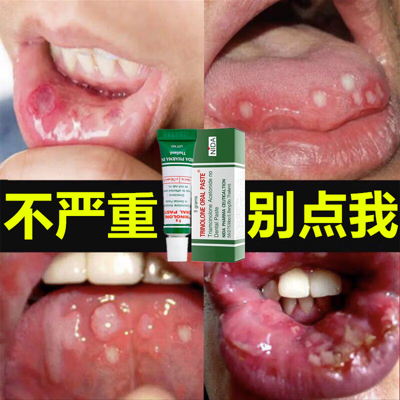 trinolone oral paste泰国口腔膏戴挪伦nida口腔膏上火起泡口腔护