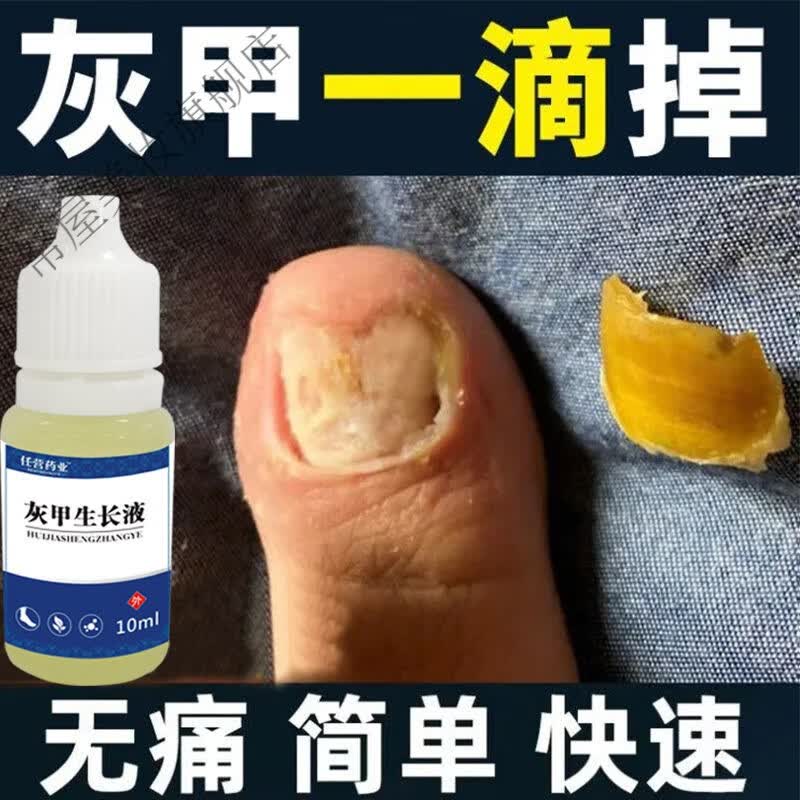 【10分钟坏甲不见了】灰指甲治i疗灰甲王祛除灰指甲专用液 一盒装