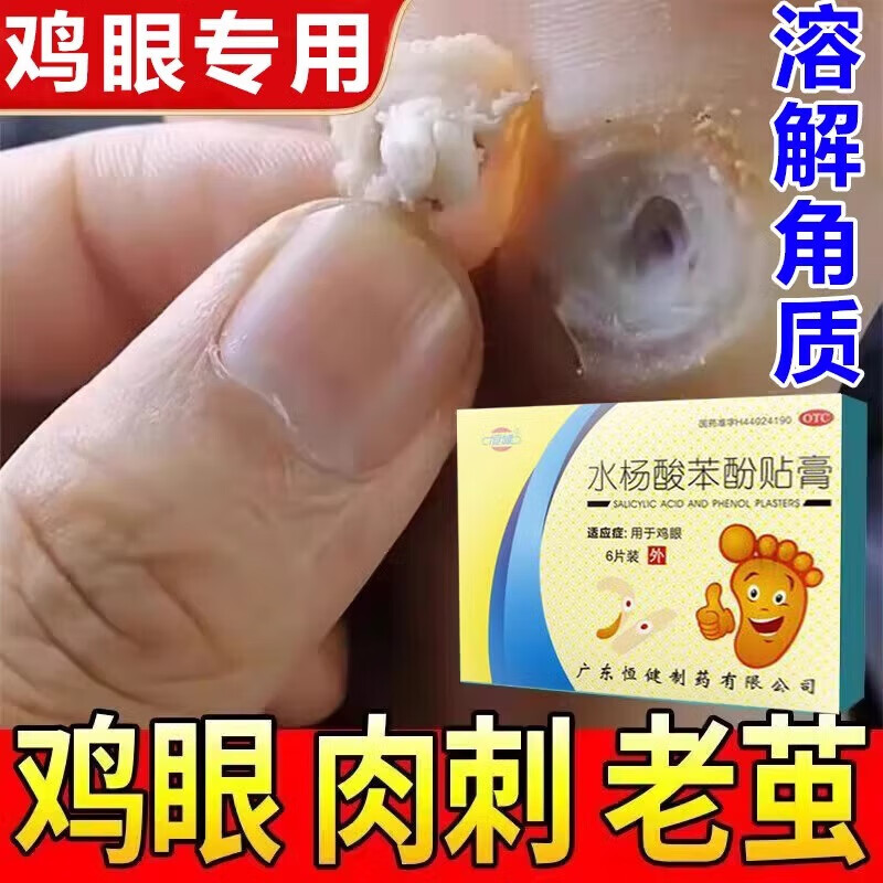 水杨酸苯酚贴膏祛鸡眼膏去鸡眼好药祛鸡眼老茧治鸡眼的特贴膏去鸡眼