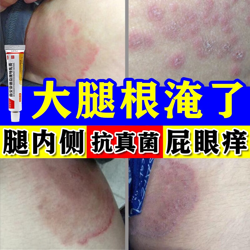 股癣专用药膏 股癣膏大腿根内侧臀部真菌感染 阴囊私处潮湿瘙痒 抗菌