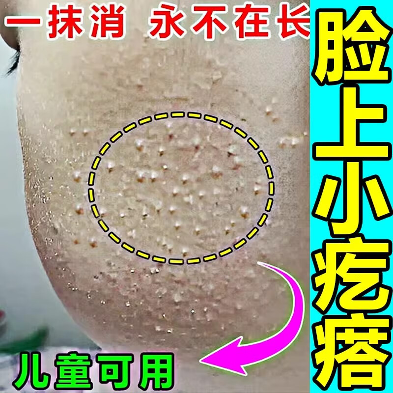仙怀堂去除闭口粉刺的克星膏下巴儿童小孩脸上有小颗粒小疙瘩清肤霜 3