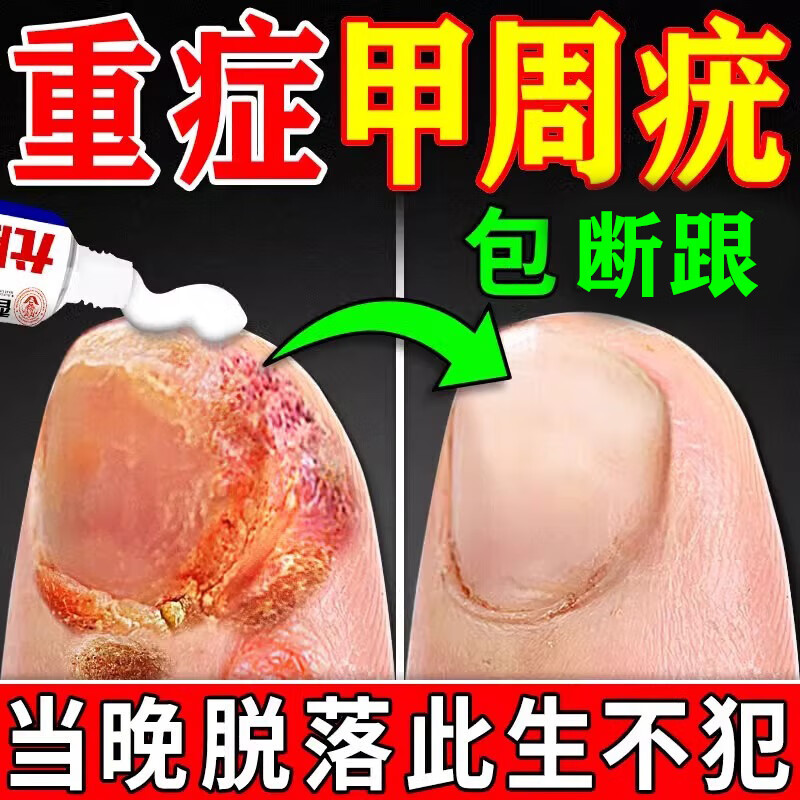 香港药房甲周疣专用膏药治疗手上长疣瘊子儿童甲下疣甲旁疣瘊肉粒一抹