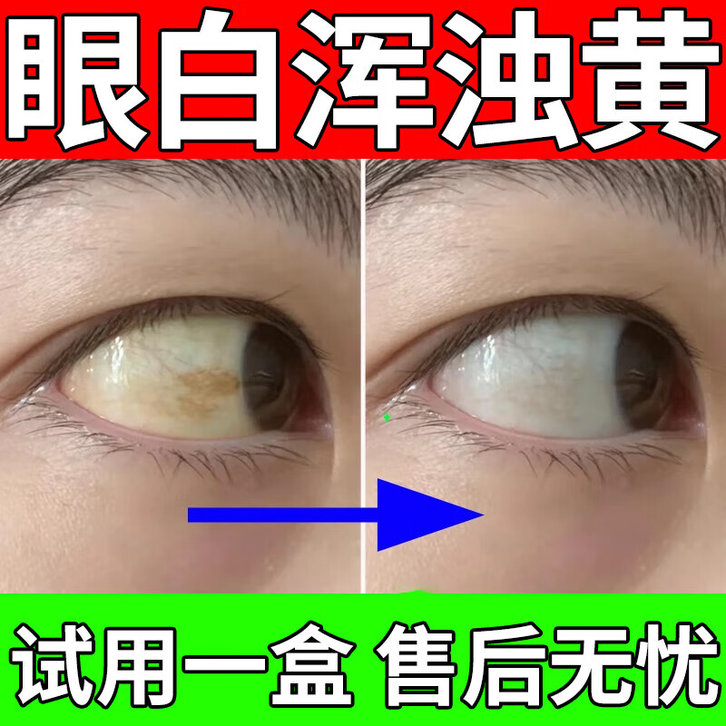 黄斑病变眼药水眼底发黄出血眼睛混浊视物模糊看不清眼白清澈眼底去i