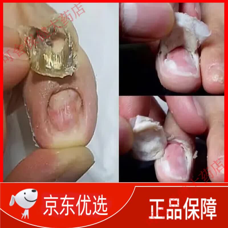 灰指甲药膏指甲真菌感染脱甲坏甲灰指甲抑菌液灰指甲液脱甲膏增厚抑菌