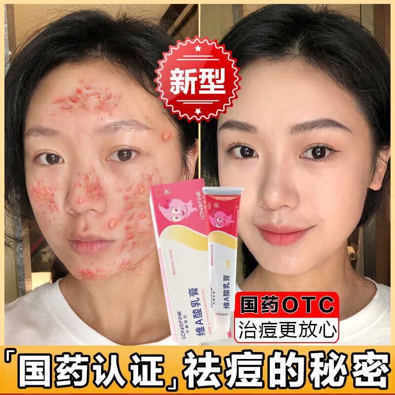 脸上长痘痘痤疮专用otc药 青春期祛痘修复淡化痘印痘坑修复药膏祛痘痘