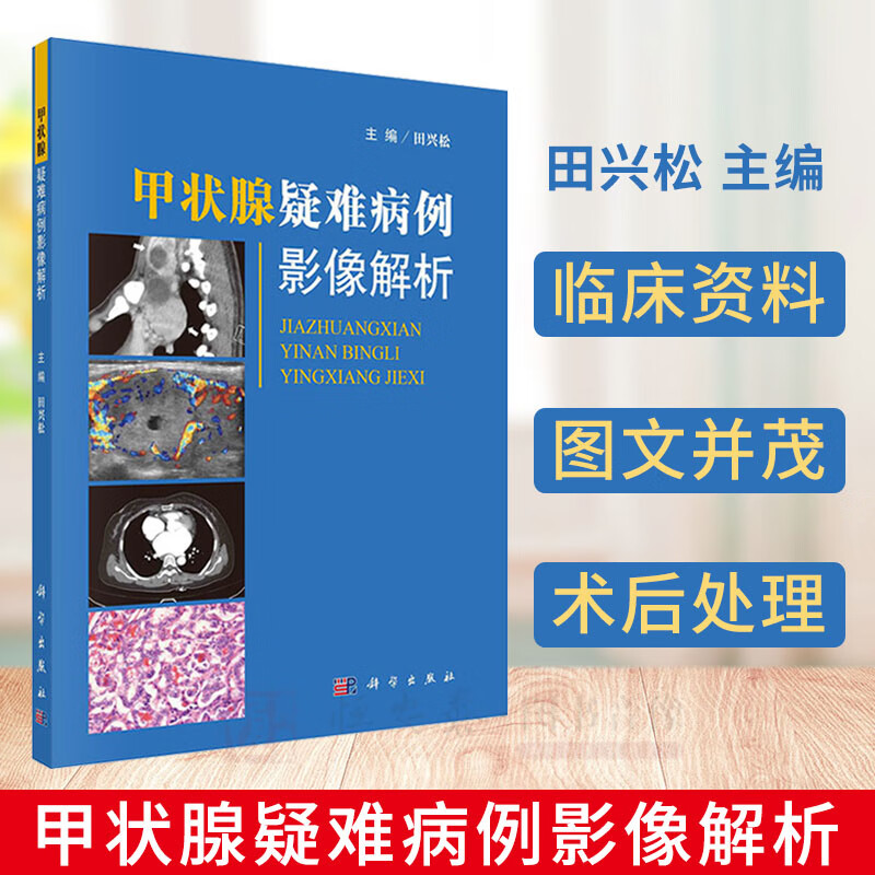 甲状腺疑难病例影像解析 田兴松 编 甲状腺恶性肿瘤 甲状腺转移性肿瘤