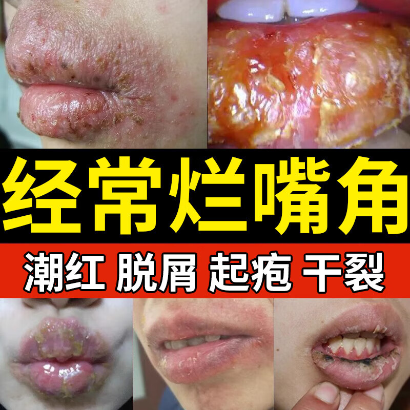 口角炎烂嘴角药膏 嘴角溃烂唇炎专用药膏嘴唇干裂脱皮上火起泡红肿