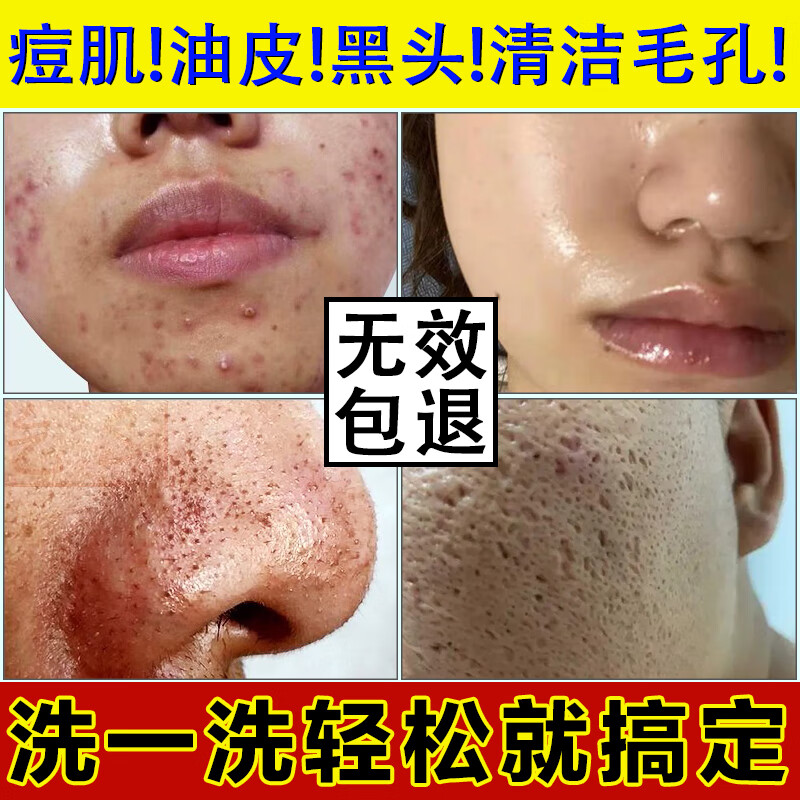 植肌男士洗面奶控油祛痘去黑头收缩毛孔泡沫氨基酸洁面乳女深层清洁