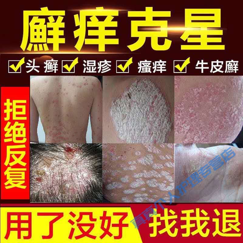 病藓膏皮l炎荨l麻疹阴肛囊大腿内侧皮肤瘙痒手足l癣红l斑外专用中草药