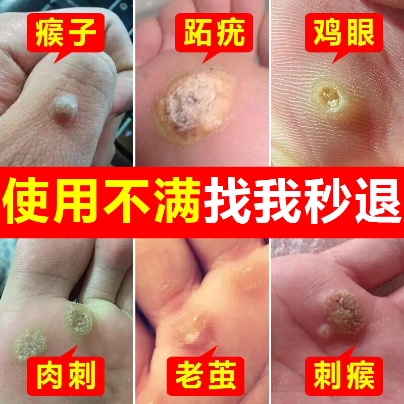 北京同仁堂 跖疣脚底趾疣专用膏刺猴脚垫鸡眼老茧丝状疣扁平疣成人去